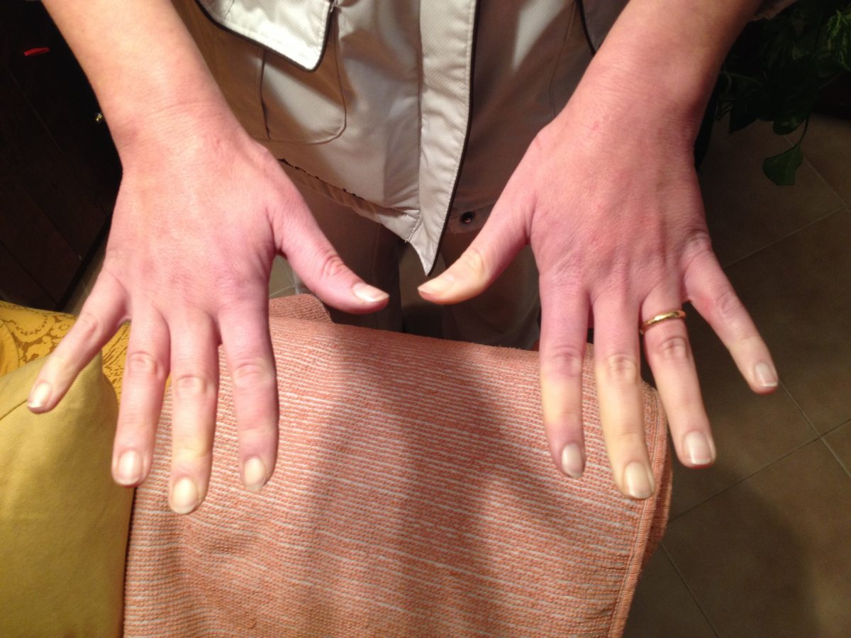 raynaud