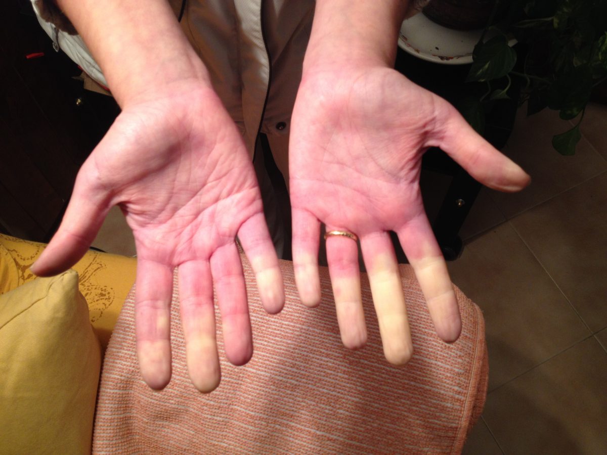 raynaud